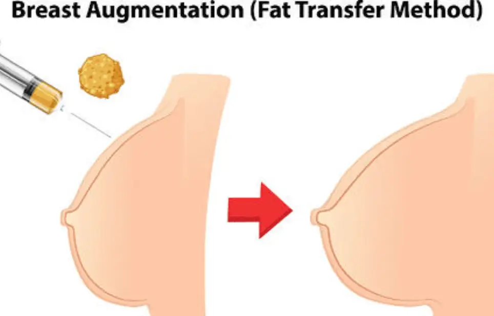 breast fat grafting in indore, breast surgery in indore