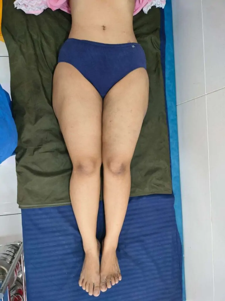 **Liposuction Clinic in Indore – Bodyshaping Clinic by Dr. Nilesh Dehariya** If you are looking for the most trusted **Liposuction Clinic in Indore**, Bodyshaping Clinic by **Dr. Nilesh Dehariya** stands as the leading destination for advanced cosmetic surgery and body contouring treatments. With years of expertise in the field, Dr. Dehariya has helped countless patients in Indore achieve their dream body through safe, effective, and scientifically proven fat reduction methods. At our clinic, we specialize in a wide range of **liposuction treatments**, including **VASER liposuction, laser liposuction, tummy tuck surgery, mommy makeover, and non-surgical body sculpting solutions**. As the demand for cosmetic surgery continues to grow in Indore, Bodyshaping Clinic remains at the forefront, offering **personalized treatment plans** designed to deliver natural-looking results. Our **Liposuction Clinic in Indore** is equipped with cutting-edge technology and modern facilities to ensure every patient receives the highest level of care. Whether you want to reduce stubborn fat from your abdomen, thighs, arms, love handles, or back, we provide tailored procedures that reshape your body safely. Patients from across Indore and nearby cities trust Dr. Nilesh Dehariya for his professional approach, surgical precision, and dedication to patient safety. What makes Bodyshaping Clinic stand out among other **liposuction clinics in Indore** is our focus on holistic transformation. We not only remove unwanted fat but also help patients achieve improved skin tightening, better body proportions, and enhanced confidence. With treatments like **RF-assisted liposuction, non-surgical lipolysis, and Brazilian butt lift surgery**, we provide comprehensive body contouring under one roof. Dr. Nilesh Dehariya, a highly qualified and board-certified cosmetic surgeon in Indore, ensures that every procedure follows strict medical safety protocols. His expertise in **minimally invasive techniques** allows for faster recovery times, reduced pain, and long-lasting results. Many patients choose our **Liposuction Clinic in Indore** because they receive world-class cosmetic surgery at affordable prices, without compromising on quality or safety. Our clinic also places a strong emphasis on patient education. We provide detailed consultations to explain treatment options, expected results, recovery guidelines, and post-surgery care. This transparency has made Bodyshaping Clinic one of the **most recommended cosmetic surgery clinics in Indore**. If you are searching for “**best liposuction surgeon in Indore**” or “**advanced body contouring clinic near me**,” Bodyshaping Clinic by Dr. Nilesh Dehariya is your ultimate choice. With proven results, modern technology, and a commitment to excellence, we proudly serve as the top destination for cosmetic surgery and fat reduction in Indore. Choose Bodyshaping Clinic – the trusted **Liposuction Clinic in Indore** where science meets art, and where your transformation journey begins under the expert care of **Dr. Nilesh Dehariya**.