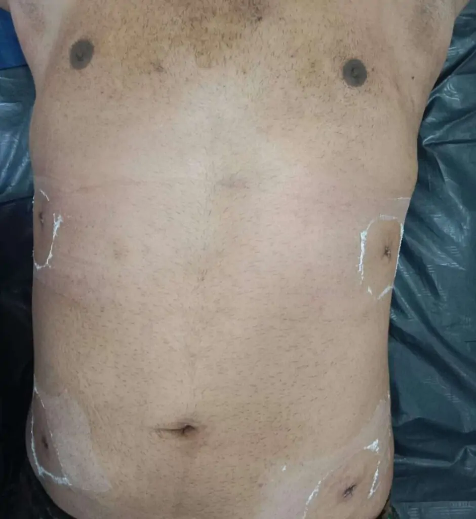 Tummy TUck Surgery In Indore