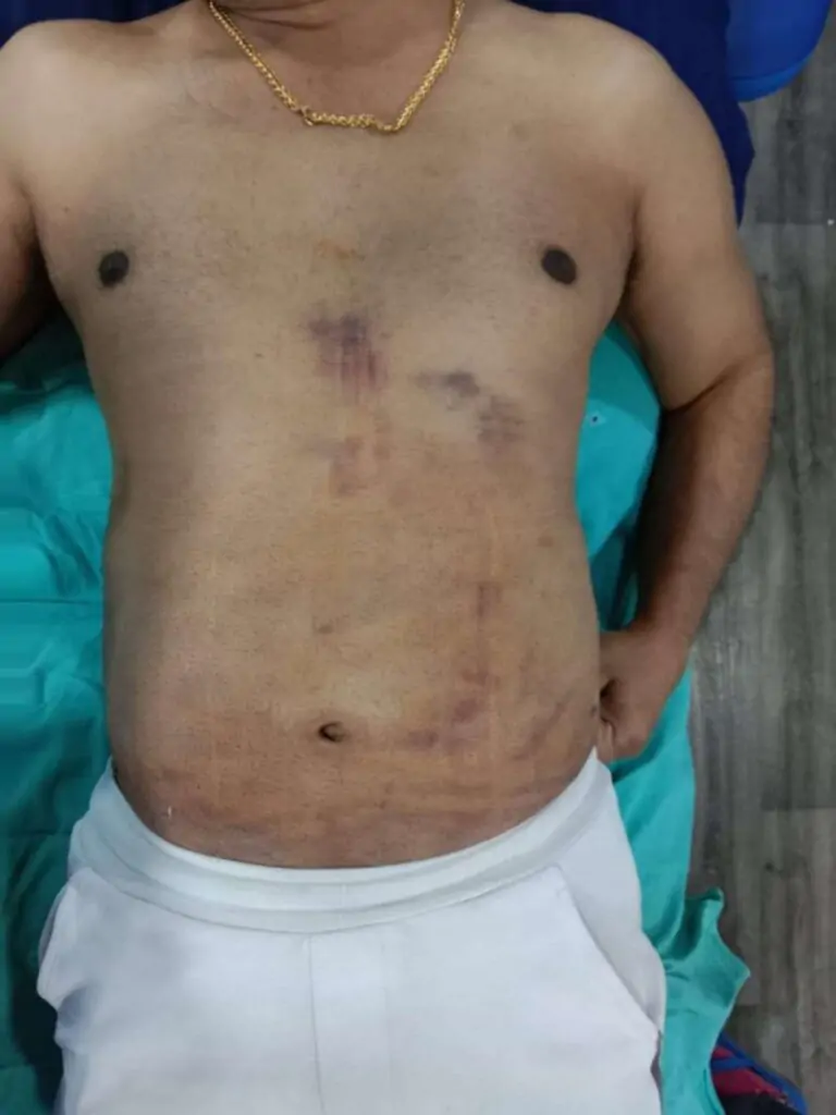 Tummy Tuck Surgery In Indore