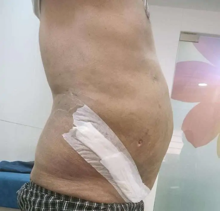 Tummy TUck Surgery In Indore