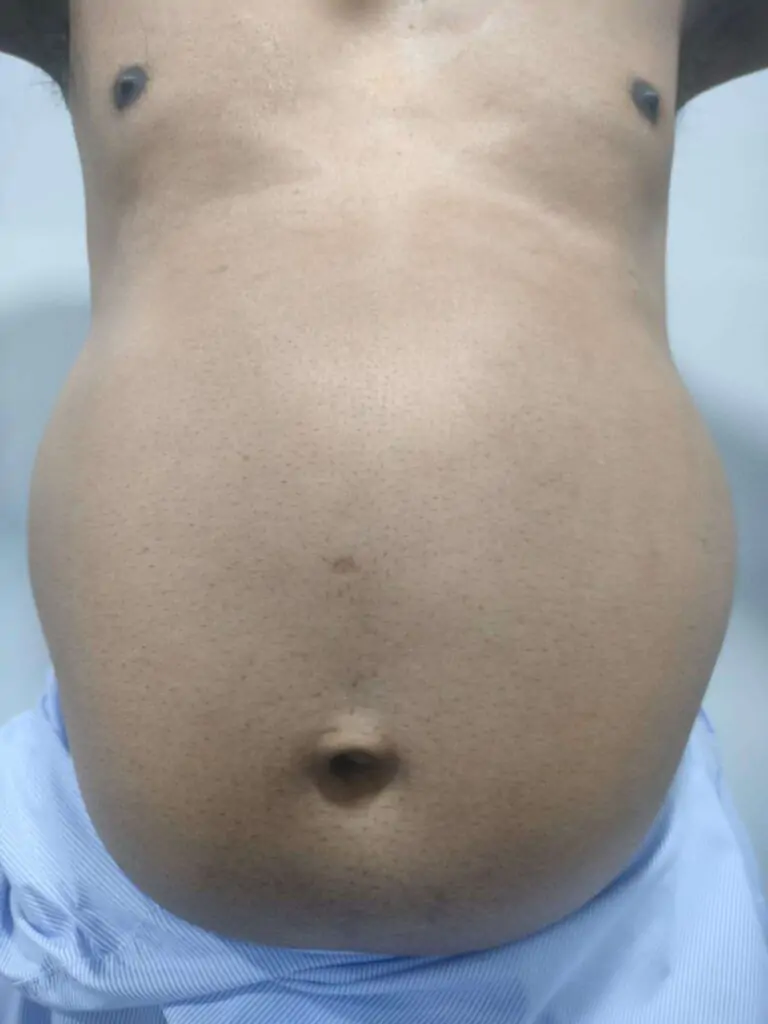 Abdominoplasty Surgery in Indore