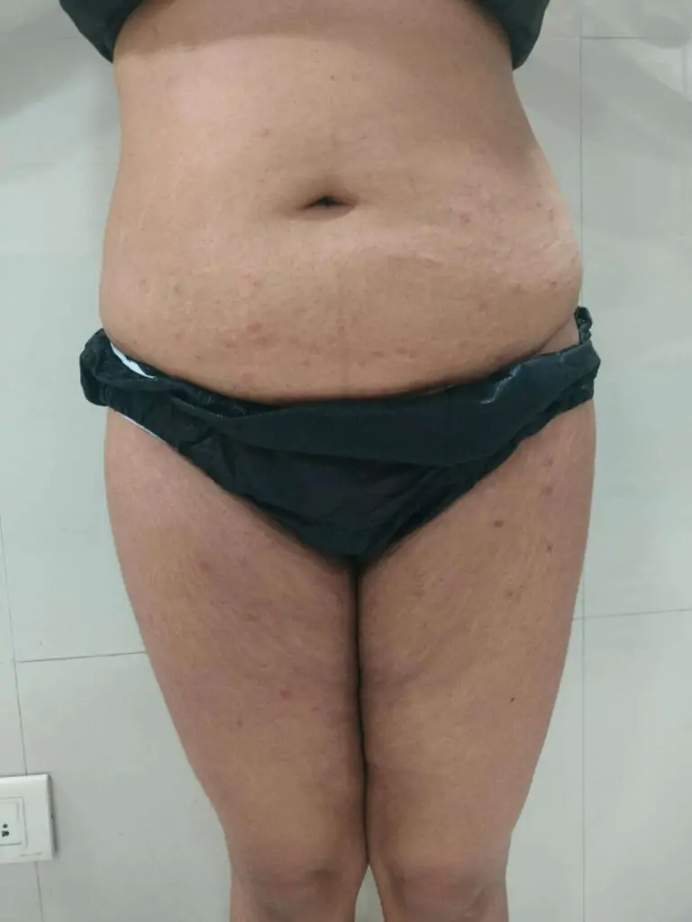 Abdominoplasty Surgery In Indore , post Pregnancy Belly Tuck