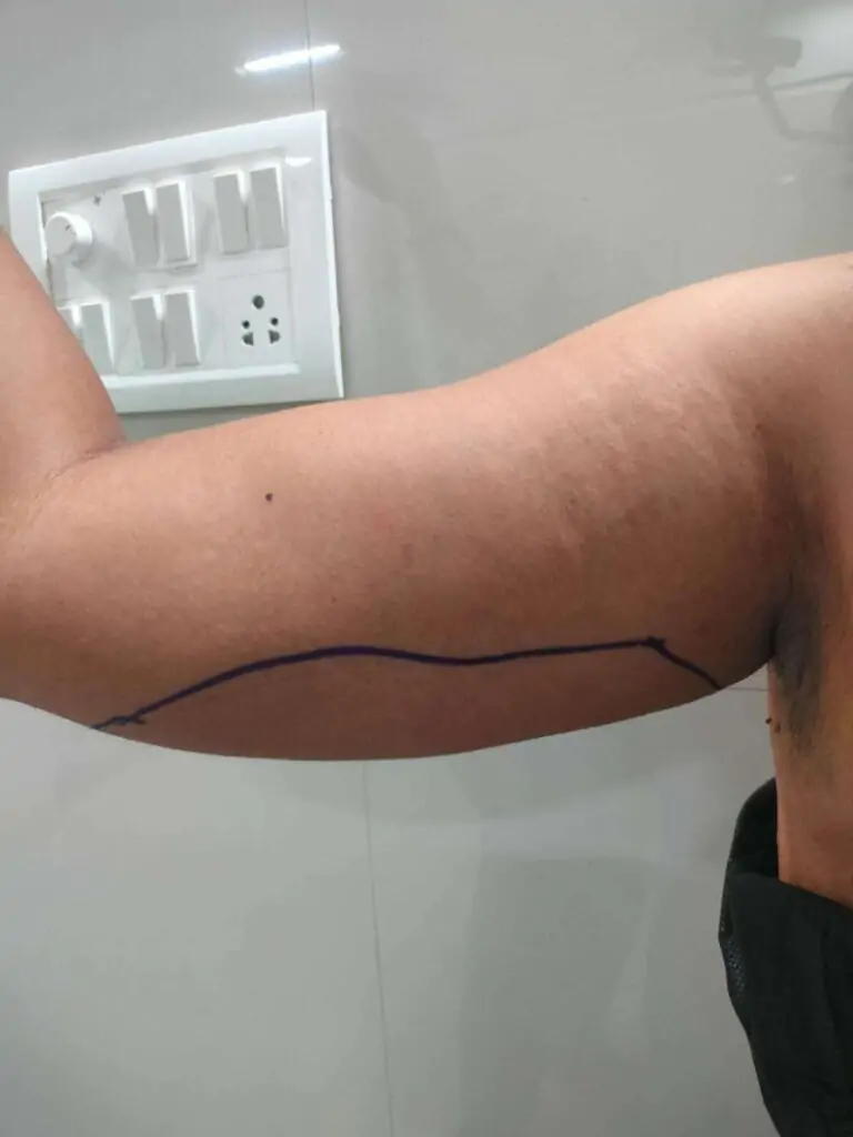Arm Liposuction , Arm Fat Loss Surgery