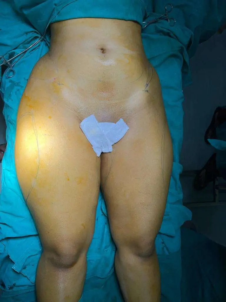 Full Body Liposuction Female
